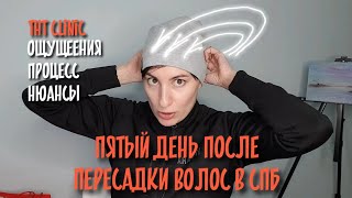 АЛОПЕЦИЯ Пересадка волос женщинам в СПБ| THT clinic | ПЯТЫЙ день после трансплантации|январь 2023 г.