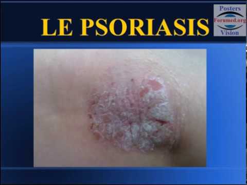 Psoriasis: Formes cliniques et physiopathologie