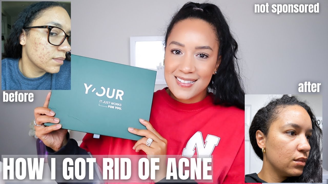 5 changes I made to help clear my acne | Y'our personalized skin care ...