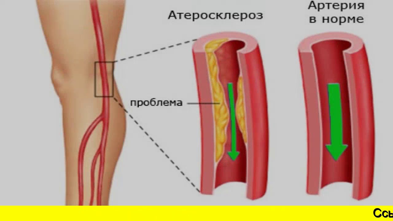 Артерий атеросклероз латынь. Атеросклероз нижних конечностей. Бляшки при атеросклерозе.
