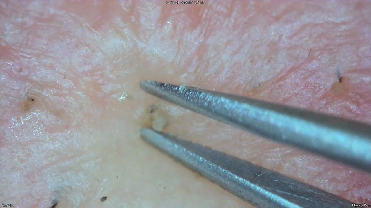 0142 keratin plug removal forehead YouTube