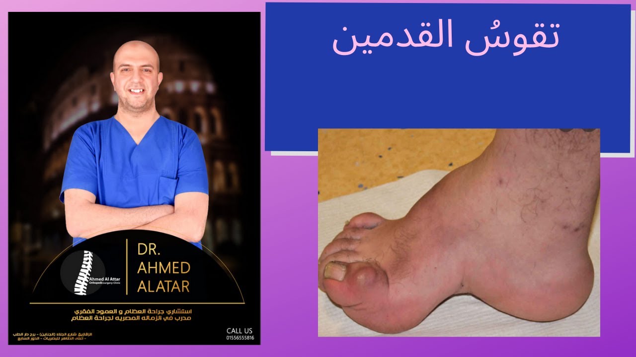 تقوسُ القدمين - القدمين ذات الاقواس العاليه