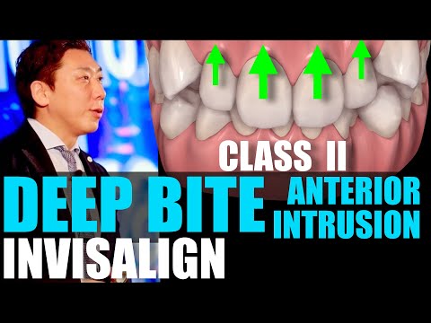 INVISALIGN CLASS II DEEPBITE NON EXTRACTION【インビザライン過蓋咬合】