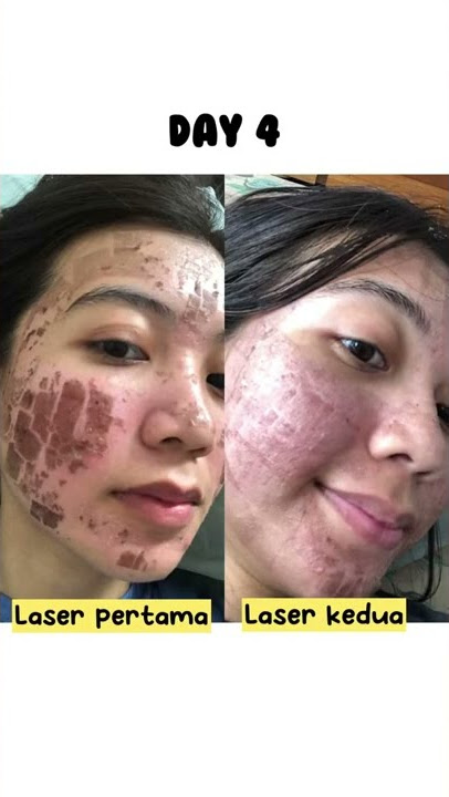 Perbedaan progress laser pertama dan kedua | luvy Amelia #co2laser