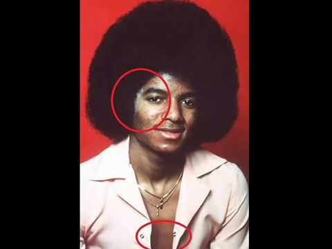  Michael  Jackson  and Vitiligo  YouTube