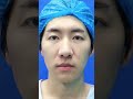 从小帅到顶帅Handsome from childhood to peak perfection.#鼻子 #nose  #医美 #整形