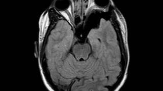 Sphenoid Wing Dysplasia