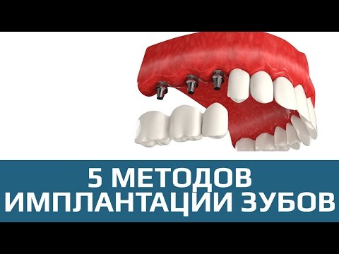 Имплантация зубов. 5 методов имплантации зубов