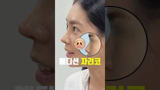 자려한 코 요즘 트렌디한 코성형의 전후 변화 #shorts #연예인코 #코수술전후