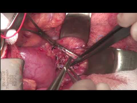 SS Splenorenal Shunt with Adrenal Vein