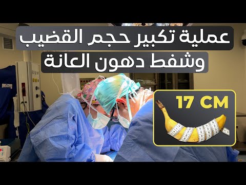 اجراء عملية تكبير وشفط دهون العانة لمريضنا من قطر