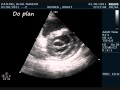 MS,MR (RHD)- ECHOCARDIOGRAPHY SERIES BY DR.ANKUR.K.CHAUDHARI