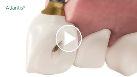 Installation procedures – Atlantis CustomBase solution with angulated screw access (with subtitles