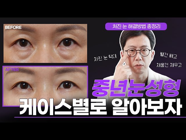 [중년 눈성형] 처진 눈 개선하는 중년 눈성형! 증상별 수술 방법과 전후 변화까지 한 방에 확인하기👀 #그레이스성형외과 #상안검 #눈썹거상 #눈매교정 #지방이식