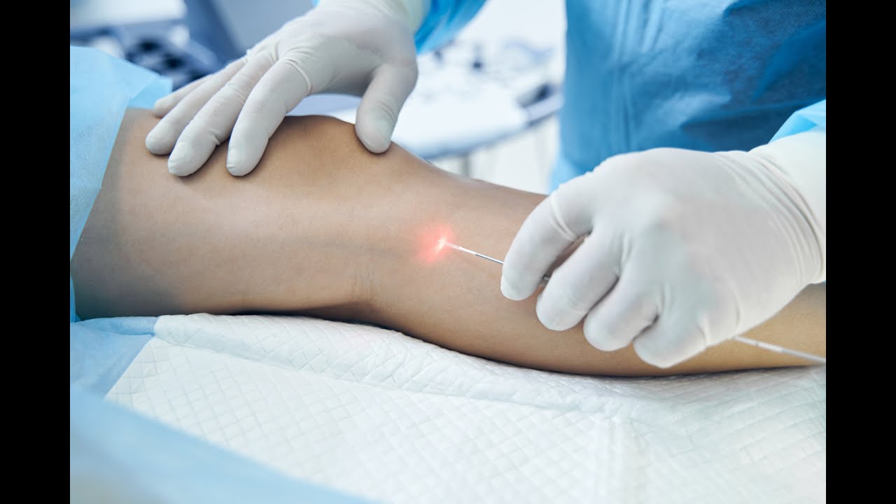 Laserowa ablacja ELVeS Klinika Medical Hair&Esthetic YouTube