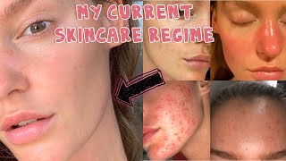 My current Skincare regime | Acne & Rosacea journey | Georgia Gibbs