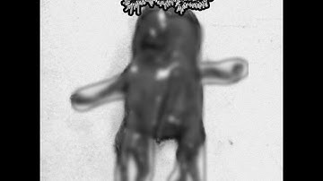 IDIOTIC -DEFORMILAZIED FETUS CAUSED BY SERIOUS MEDICAL COMPLICATIONS OF FORENSIC (Mincegore)