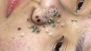 new pimple popping videos blackheads 2023 