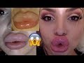 DISSOLVING MY BOTCHED LIPS FOR THE 7TH TIME!