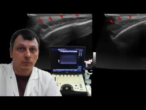 Детское УЗИ мягких тканей - Образование височной области