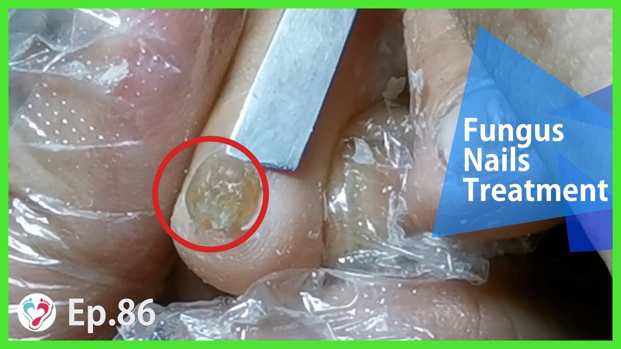 TOP MEDICAL PEDICURE Ep.86 Clipping A Little Toe Fungus Nail YouTube