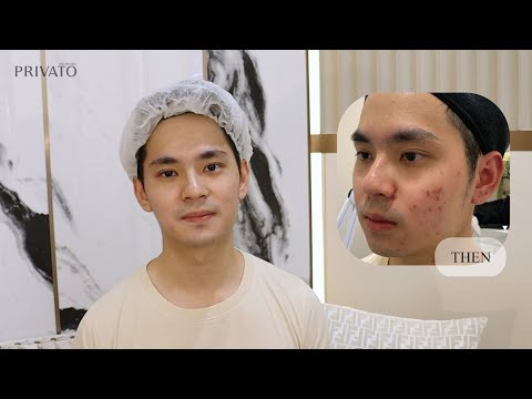 Privato Clinic นวัตกรรมการรักษาสิว