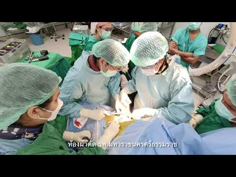 ข้อไหล่เทียมในผู้ป่วยกระดูกข้อไหล่แตกหักรุนแรง Hemishoulder shoulder Arthroplasty