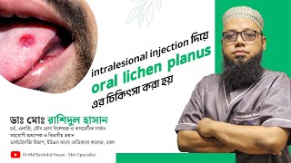 মুখগহ্বরের লাইকেন প্লানাস রোগের ইঞ্জেকশাকনের মাধ্যমে চিকিৎসা screenshot 1