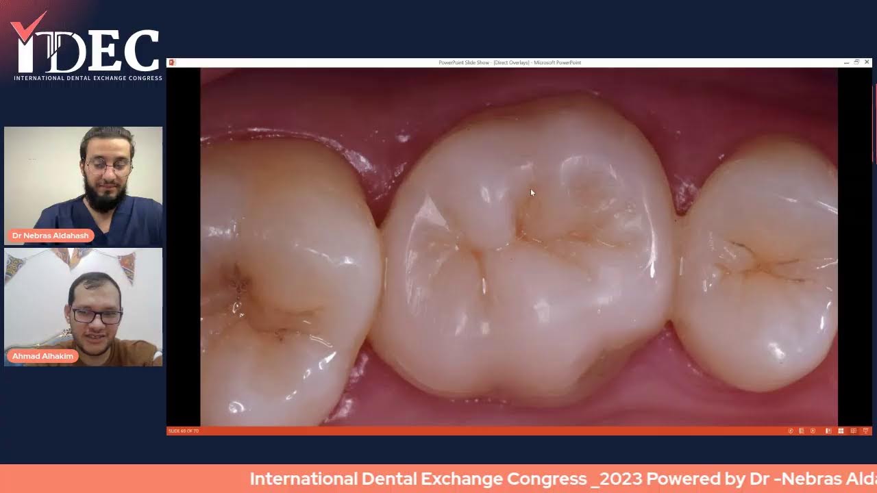 DIRECT COMPOSITE  - ONLAY - OVERLAY  , Dr Ahmed Alhakeem 🇪🇬