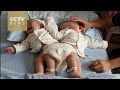Chinese conjoined twins separated with 3D technology