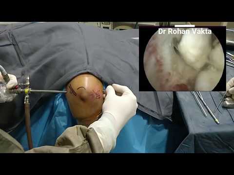 Elbow Arthroscopy