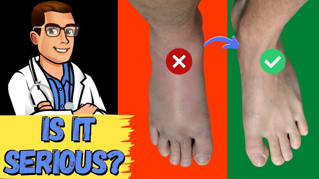 How To Tell If My Foot or Ankle Injury is BAD! [Sprained or BROKEN ...