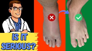 How To Tell If My Foot or Ankle Injury is BAD! [Sprained or BROKEN?] screenshot 5
