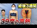 【脂肪吸引後3週間】突然39℃の高熱…実は蜂窩織炎でした【実例を公開】