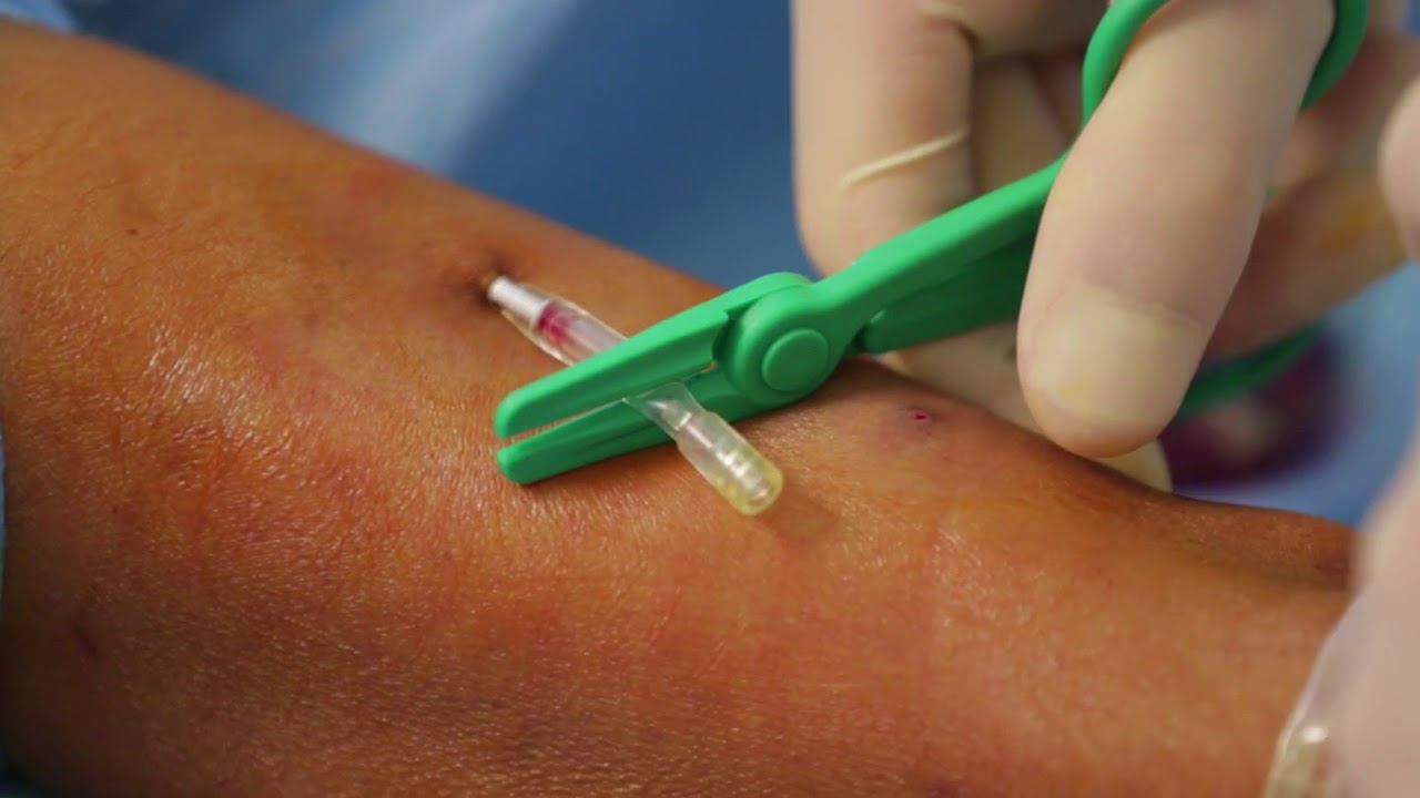 Ponction fistule avec technique Buttonhole YouTube Ponction fistule avec technique Buttonhole YouTube