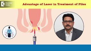 Piles or Hemorrhoids - Benefits of Laser Surgery | Get rid of PILES -Dr. Sujay B R | Doctors