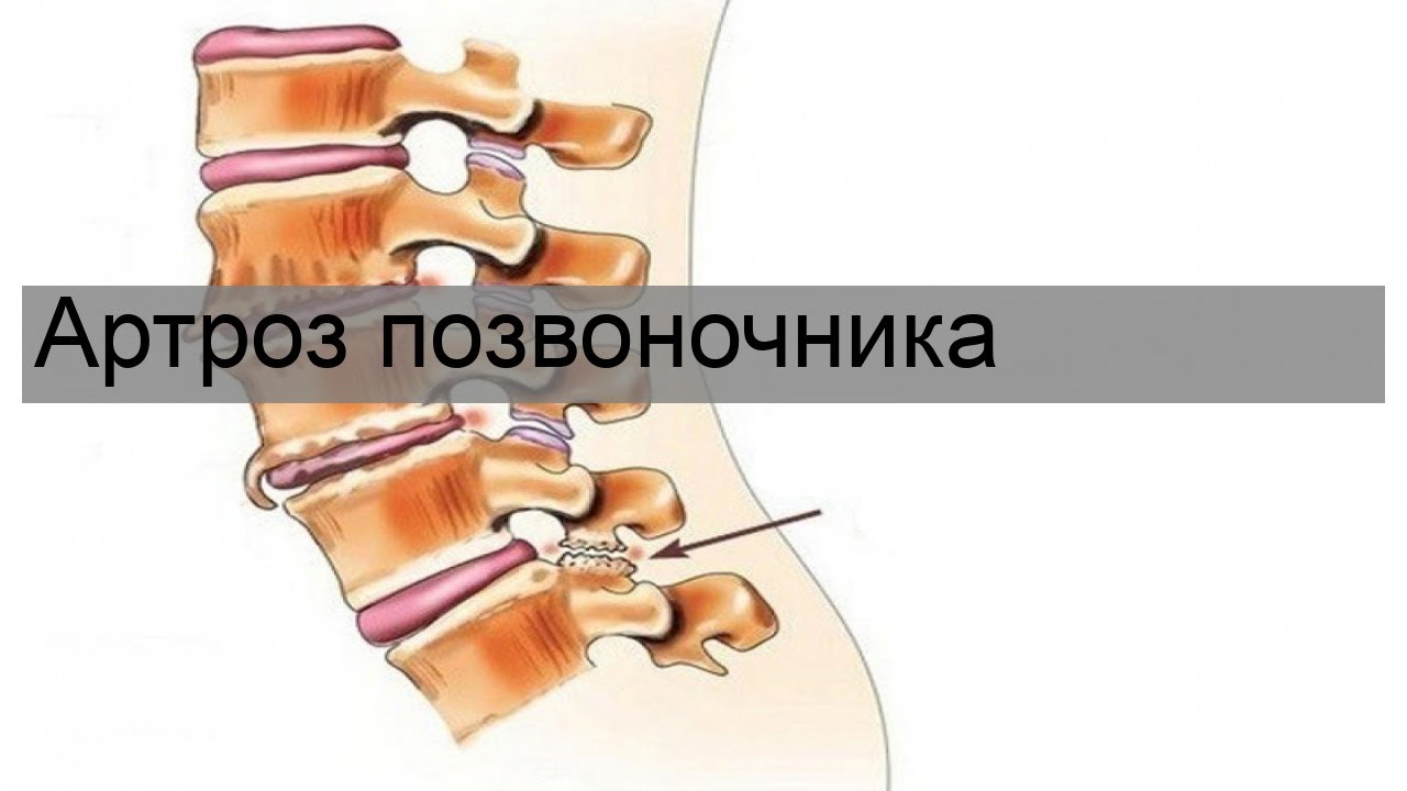 Изменение поясничного отдела позвоночника остеохондроз спондилоартроз