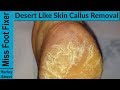 The right way to remove foot callus   FULL TREATMENT #4 part 1
