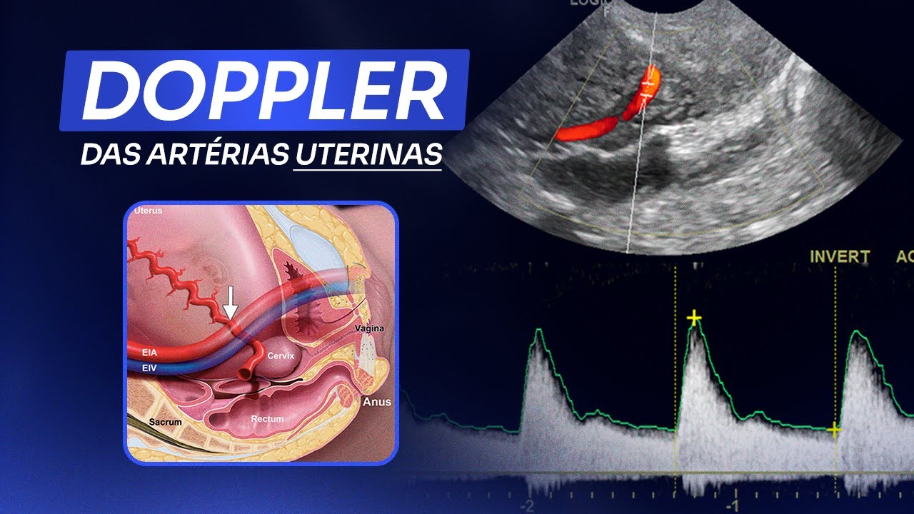Doppler das Artérias Uterinas | Ultrassom obstétrico - YouTube