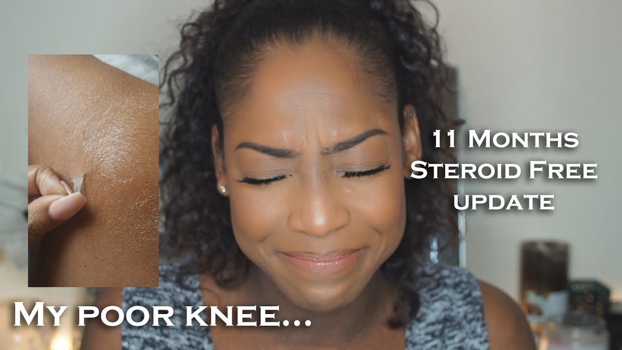 Topical Steroid Withdrawal 11 Month Update Eczema Awareness YouTube