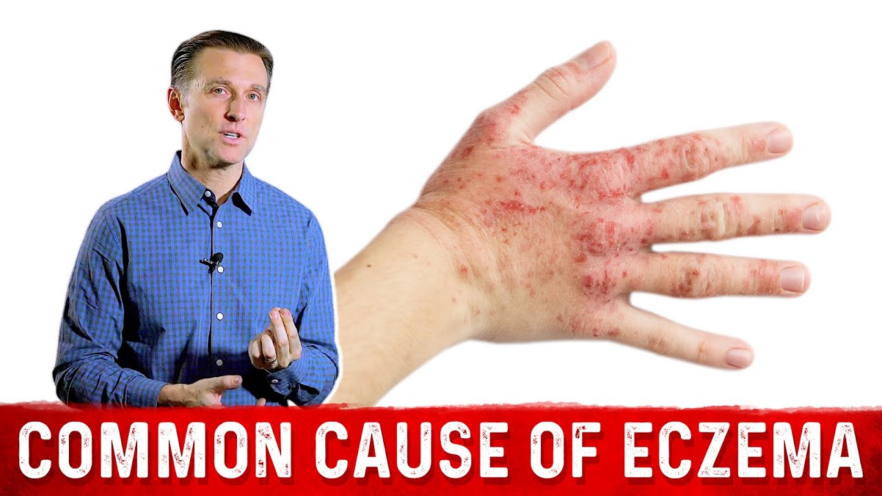 Is Your Eczema Coming from a Salicylate Sensitivity? Dr. Berg On
