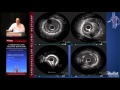 IVUS and FFR (Colin Barker, MD)