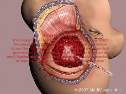 Performing a Craniotomy Flap