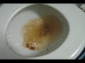 Rihanna Disturbia Parody - "Diarrhea"  -  FUNNY!