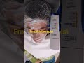 کربوکسی تراپی با برند تنورا 