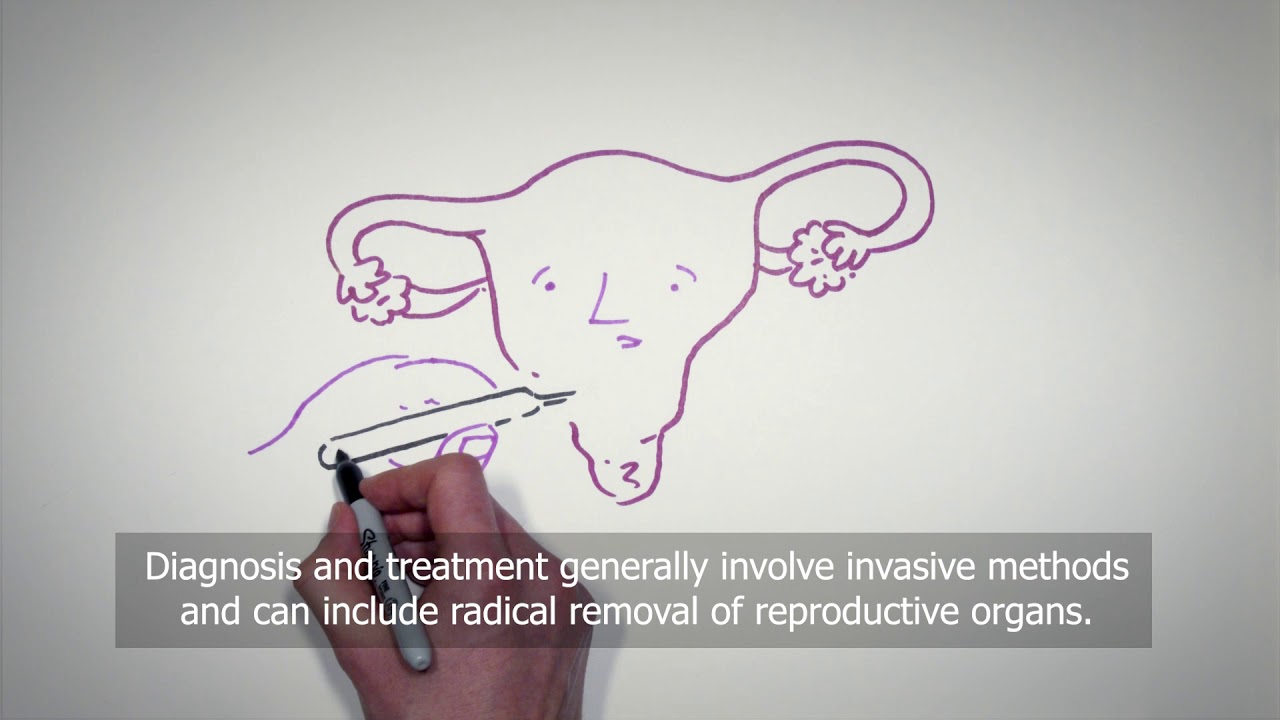 Predicting women’s risk of endometrial cancer