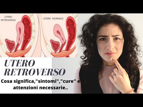 Video: Come invertire l'utero retroverso?