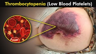 Thrombocytopenia: Causes, Symptoms and Treatment (3d Animation) / low blood platelets