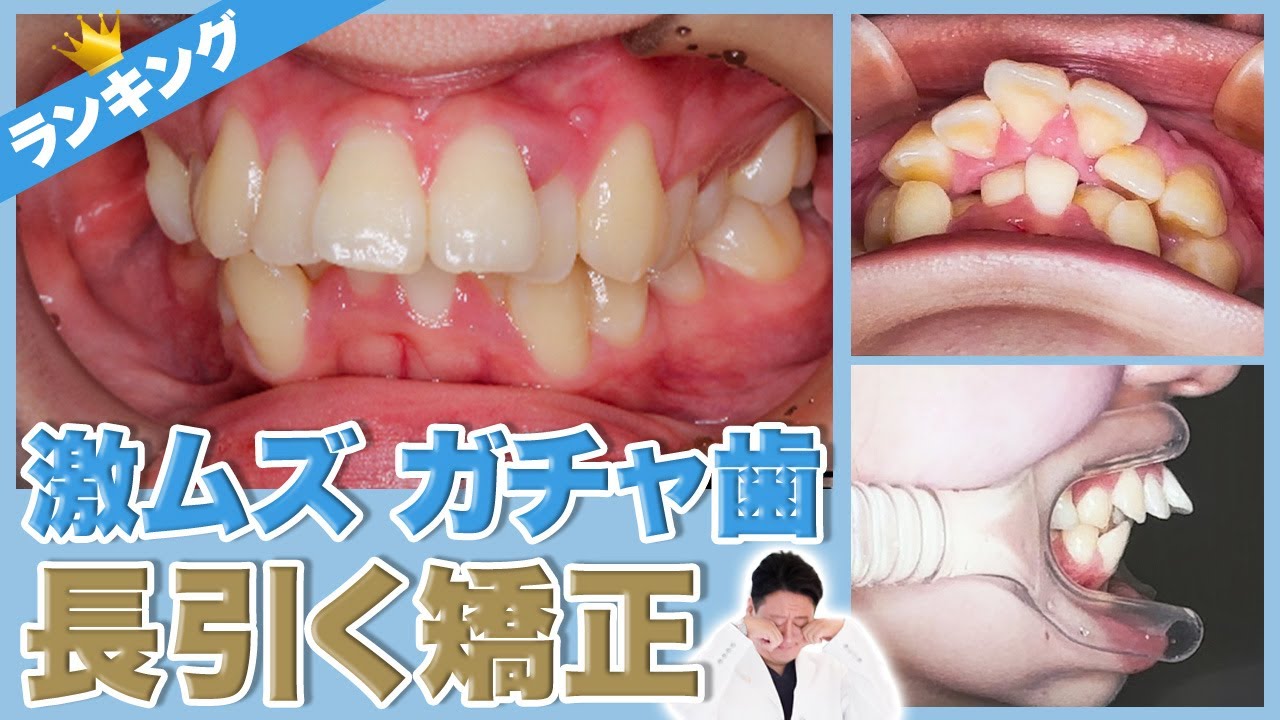 【ランキング】激ムズガチャ歯！矯正期間が長引いた症例を解説します【審美歯科 歯列矯正 歯並び 歯医者】