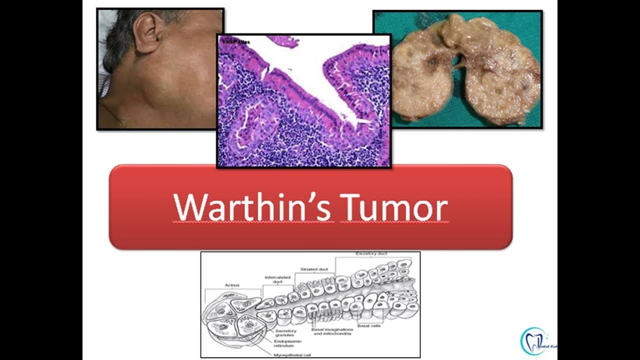 Warthins Tumor Youtube
